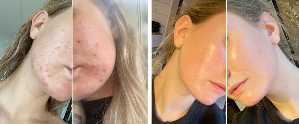 frida-tok-knekken-pa-hormonelle-kviser-koreansk-hudpleie