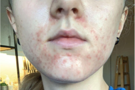 lisa erfaring koreansk hudpleie hormonelle kviser maskne