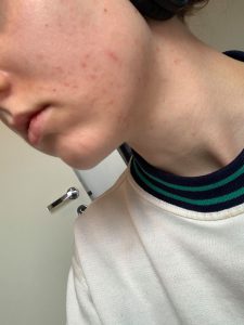 lisa erfaring koreansk hudpleie hormonelle kviser resultat